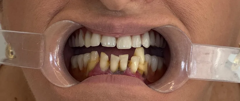 Înainte de tratament: probleme dentare Caz clinic înainte: dinți afectați, carii, nevoie de tratament stomatologic