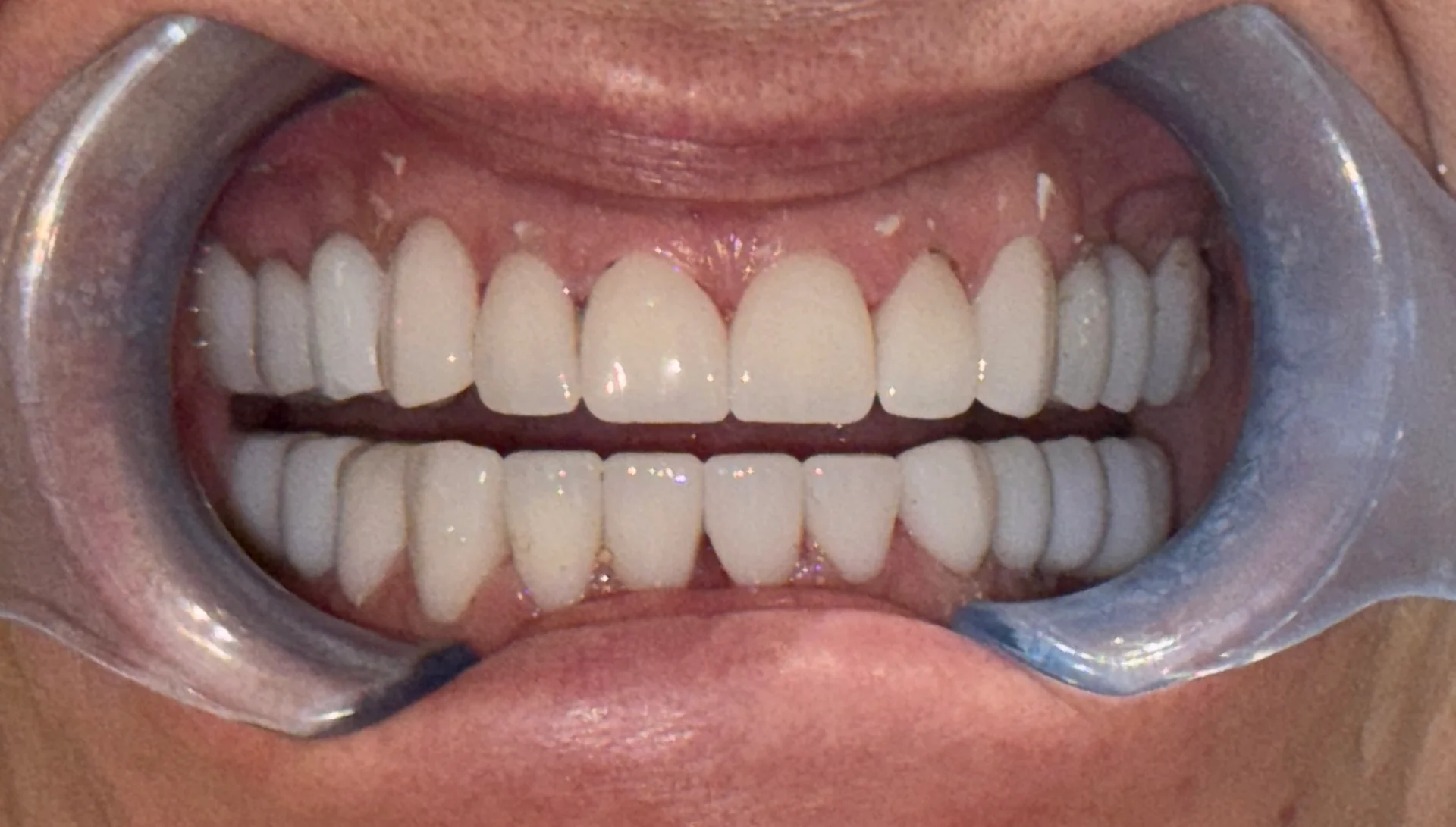 Zâmbet nou cu Denteca Smile Clinic Zâmbet transformat cu fațete dentare realizate la Denteca Smile Clinic