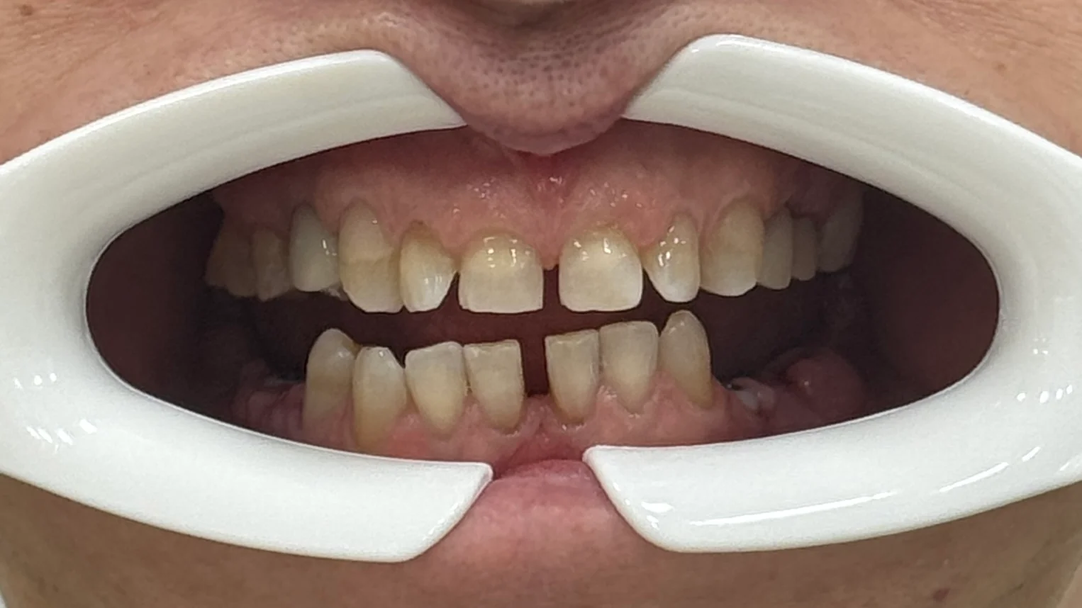 Înainte de tratament - aspect inițial Caz clinic Denteca Smile Clinic: dinți îngălbeniți, spații interdentare