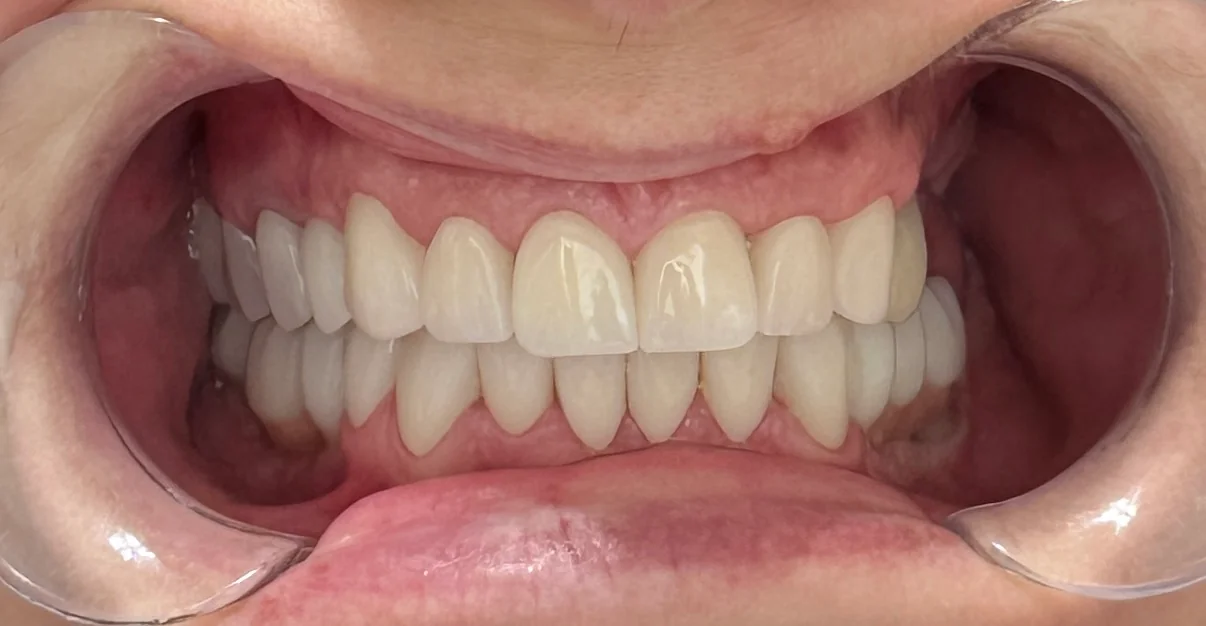 Zâmbet transformat Denteca Smile Clinic Caz clinic final: zâmbet perfect obținut la Denteca Smile Clinic