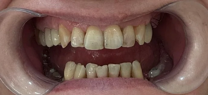 Zâmbet înainte de tratament la Denteca Caz clinic înainte de tratament stomatologic la Denteca Smile Clinic