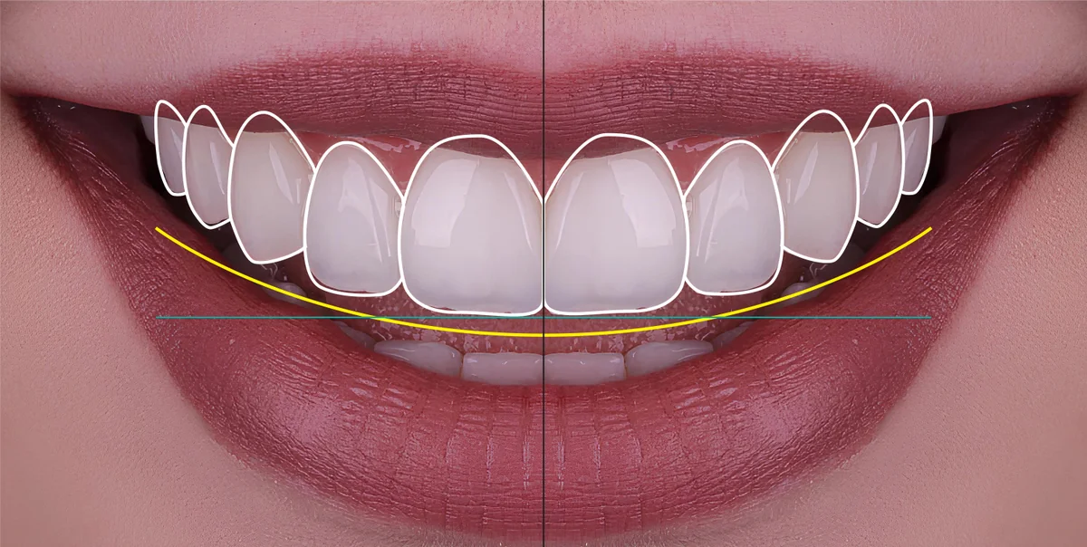 Design zâmbet digital Denteca Smile Clinic Design digital al zâmbetului la Denteca Smile Clinic București